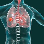 Lung Cancer Doctor in Lucknow